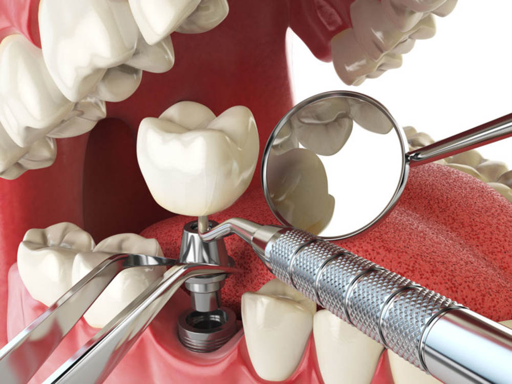 implantologia dental en Tarragona al mejor precio