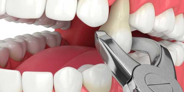 tratamiento dolor de muelas Tarragona extracción dental