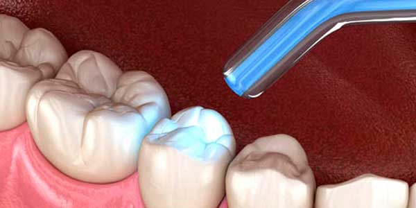 tratamiento caries en Tarragona clínica dental Rumon dentistas