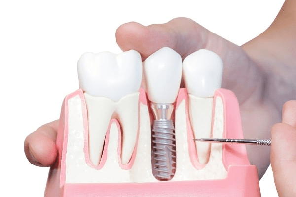 maqueta de un implante dental entre dos dientes sanos